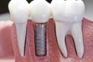 Implanturile dentare - „pentru“ și…