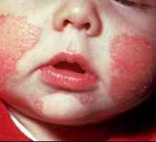 Alergia la sugari - ceea ce o nenorocire?