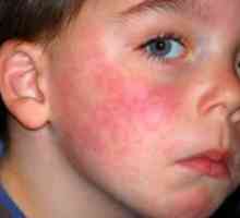 Simptomele de alergii la copii