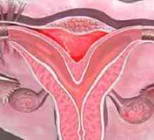 Malformații uterine