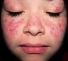 Dermatita atopica - Simptome