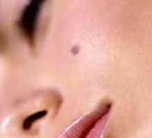 Carcinomul cu celule bazale ale pielii