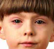 Ochii la același nivel cu conjunctivita la copii?