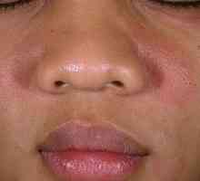 Ce este dermatita feței și cum să-l trateze?