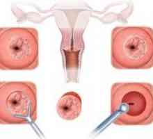 Diatermokonizatsiya de col uterin