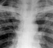 Tuberculoza diseminată