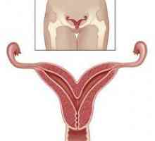 Bicorn uterului si sarcina