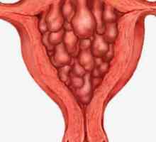 Hiperplazie endometrială - ce este?