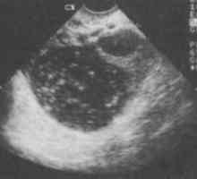 Formarea hypoechoic în ovar