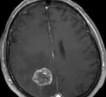 Brain Glioblastomul Grad 4