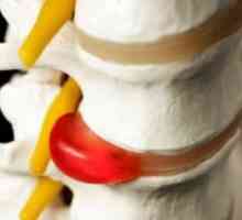 Coloanei vertebrale lombare hernie - Exercitarea