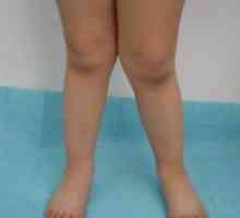 Picioare în formă de X la copii