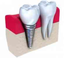 Implanturile dentare - contraindicații și posibile complicații
