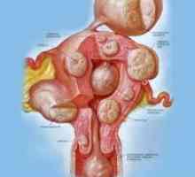 Fibrom uterin intramural