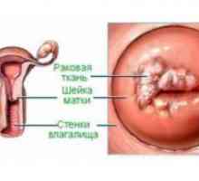 Cancer invaziv de col uterin