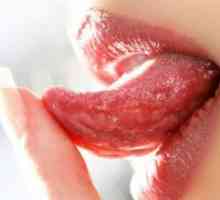 Ulcerele pe limbă