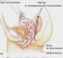 Alungire de col uterin