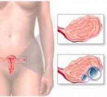 Chist ovarian endometrioid - Tratamentul