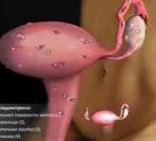 Endometrioza de col uterin - Tratamentul