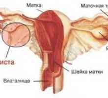 Corpus uterele Endometrioza