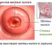 De col uterin eroziune - ce este?