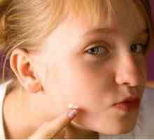 Cum de a elimina acnee pe obraji