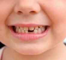 Care sunt dinții cad la copii?