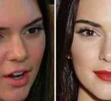 Kendall Jenner înainte și după plastic