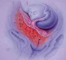 Placenta previa Marginal, 20 de săptămâni