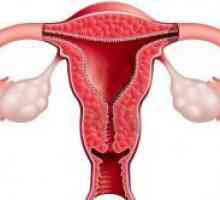 Tratamentul hiperplaziei endometriale după chiuretaj