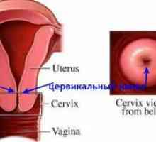 Tratamentul cervicite cronice