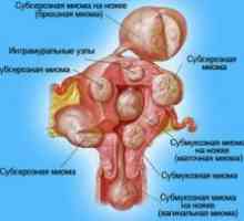 Fibromul uterin - tratament de atac folk