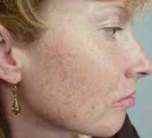 Tratamentul cicatrice de acnee pe fata