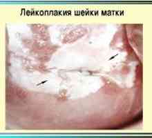 Leucoplakia de col uterin - Simptome