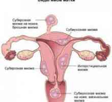 Corp uterin leiomiom