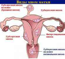 Fibrom uterin - ce este?