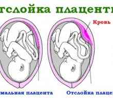 Conceptul general al fenomenului de placenta abruptio