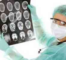 Brain tumora - simptome in stadiile incipiente