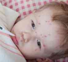 Complicațiile de la varicela la copii