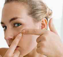 Principalele tipuri de acnee