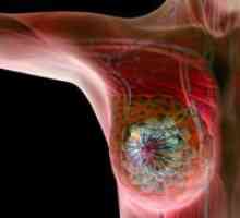 Nutriție în cancerul de sân