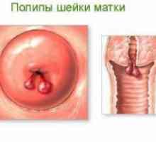 Polip la nivelul colului uterin - Cauze