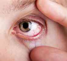 Cauzele și tratamentul inrosirea ochilor