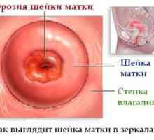 Principiile de tratament de eroziune de col uterin
