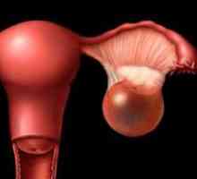Simptomele de chisturi ovariene la femei