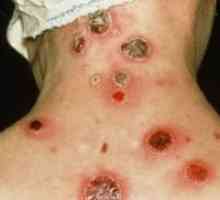 Simptomele de sifilis la femei