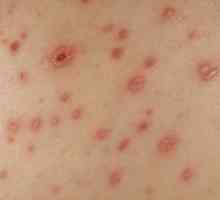 Simptomele de varicela la copii