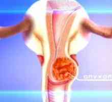 Prevenirea cancerului de col uterin