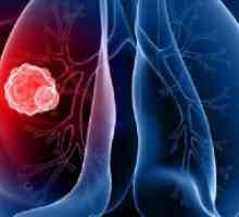 Cancerul bronhiilor - Simptome