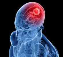 Brain Cancer - Simptome